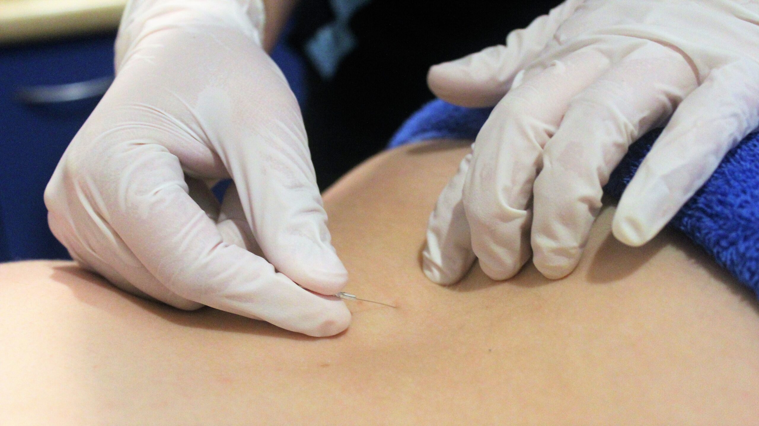 Dry Needling in Healesville & Ferntree Gully