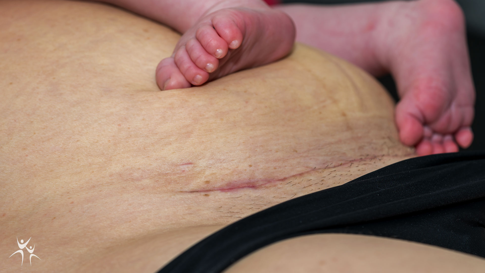 close up of woman's tummy showing c section scar 