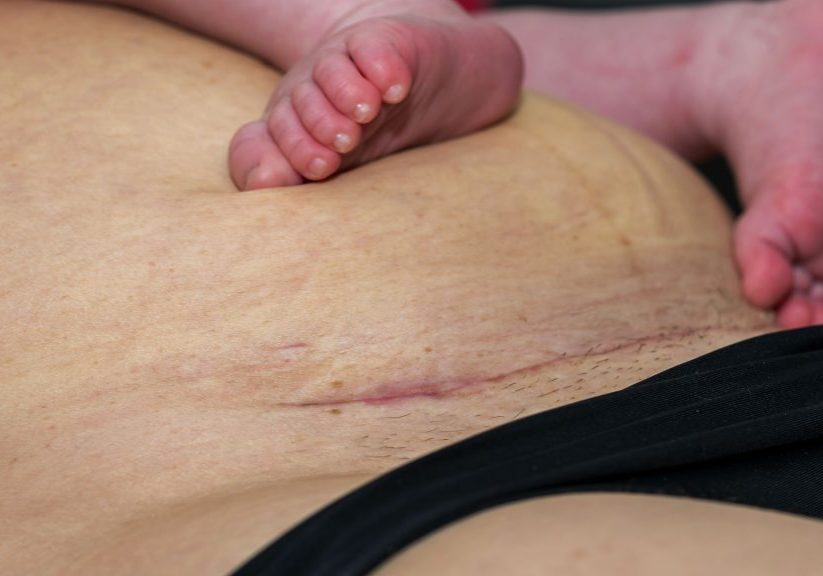 close up of woman's tummy showing c section scar 